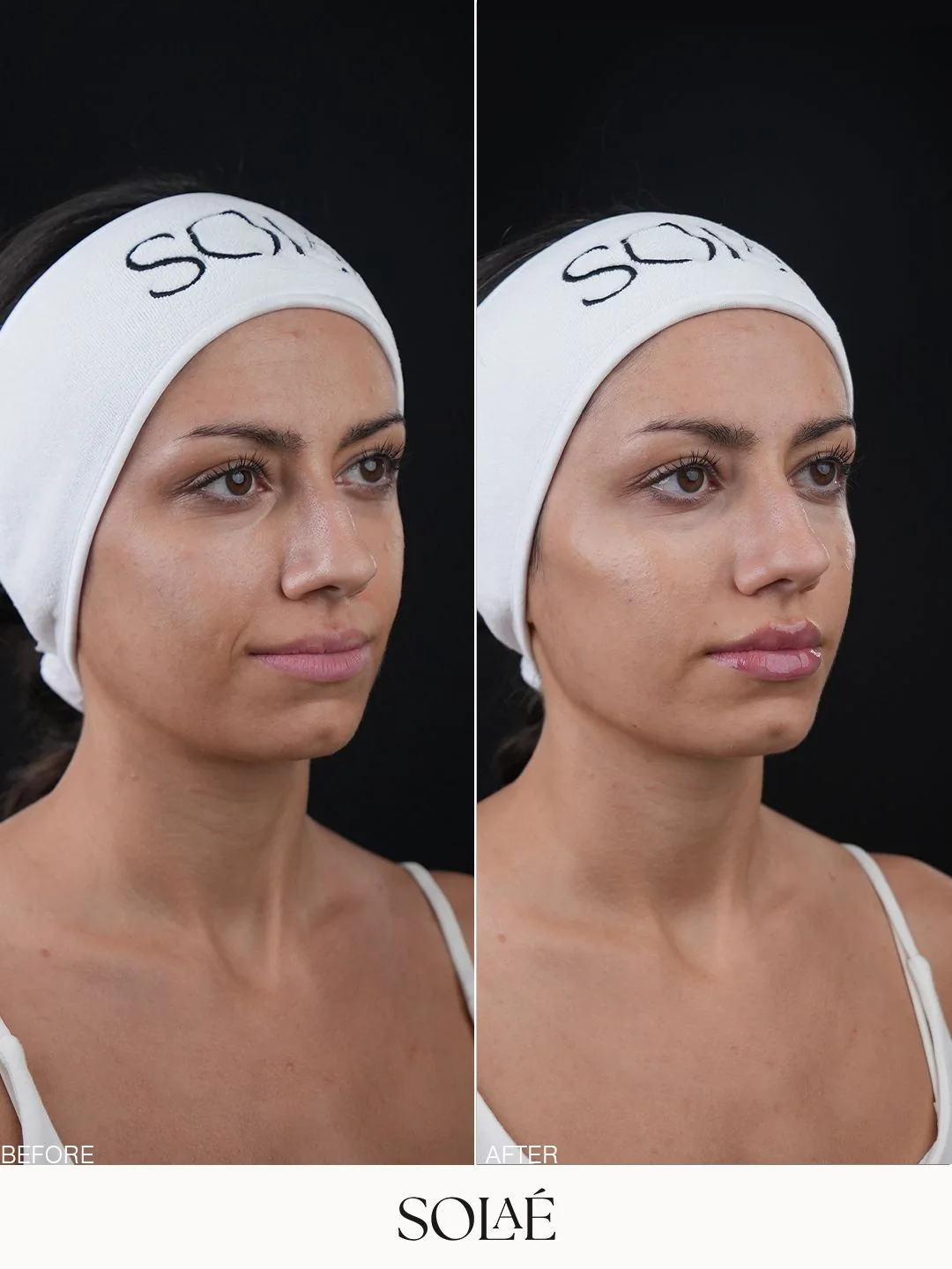 Facial contour progress