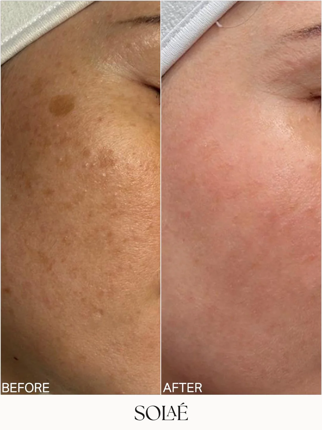 Tone and texture progress