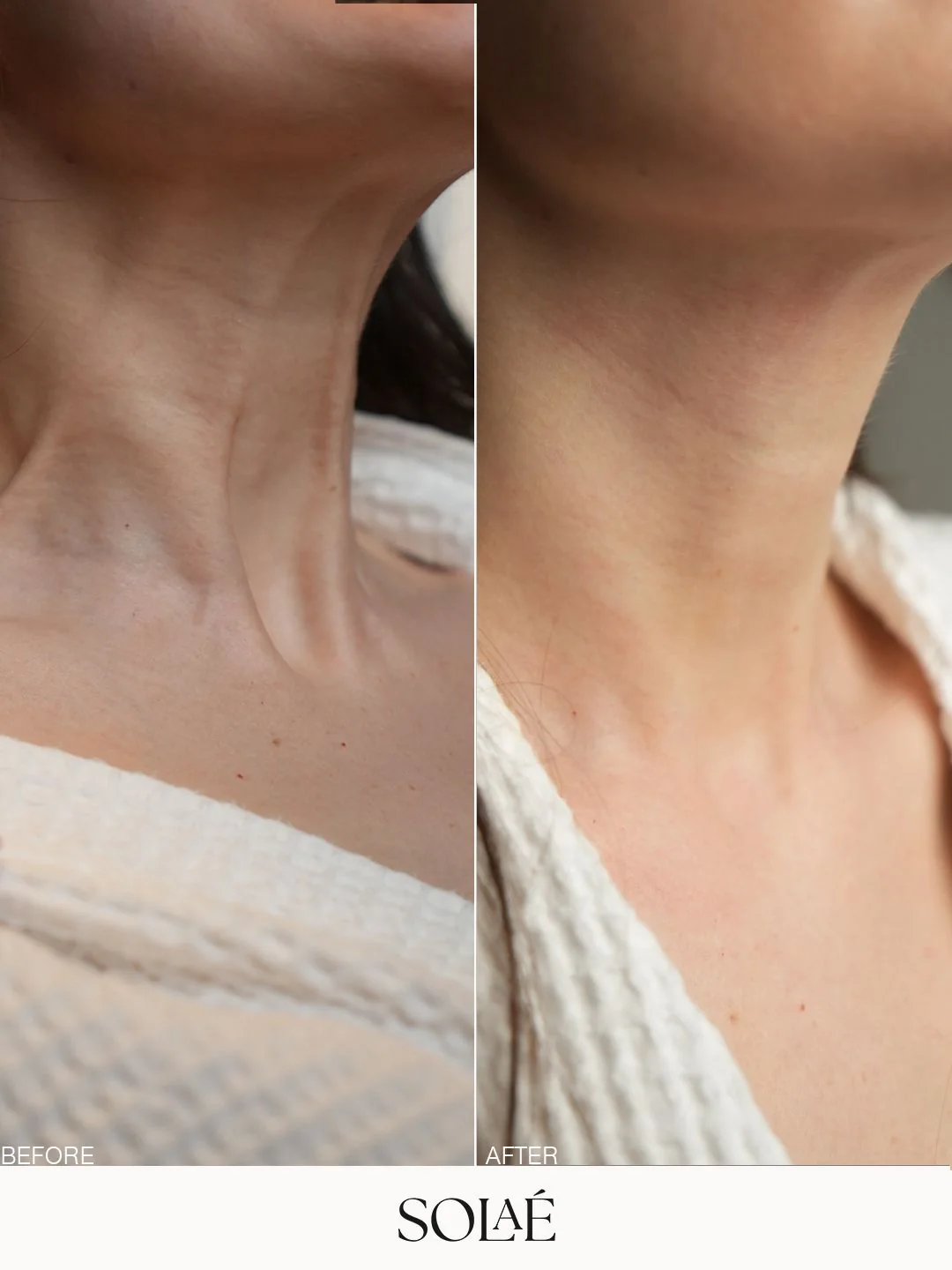 Neck and jawline care