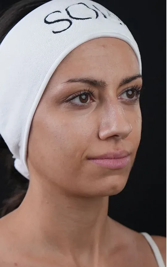 Before Biosome Bright facial balance treatment result