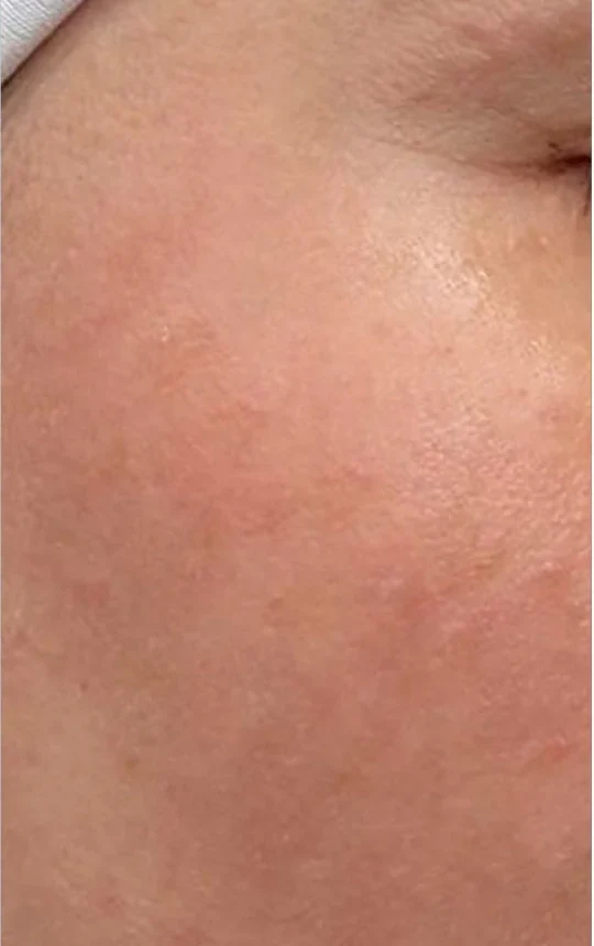 After SkinPen Precision skin texture treatment result