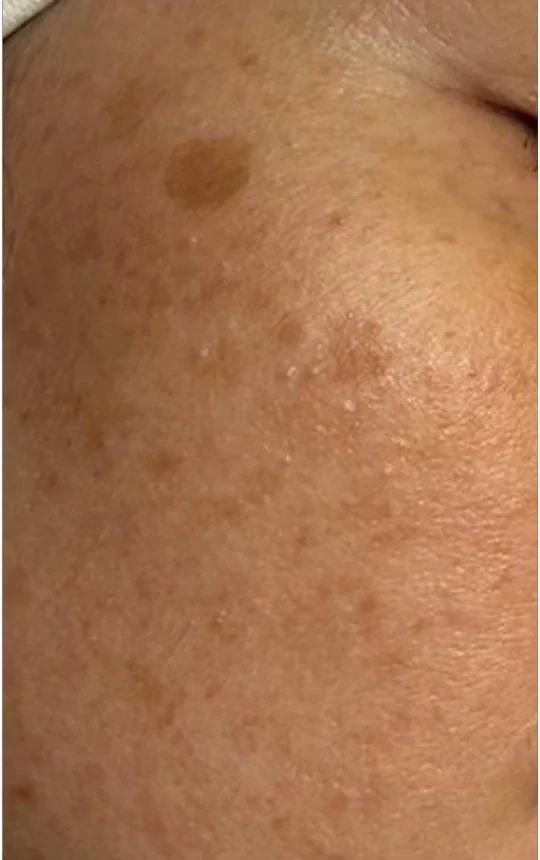 Before SkinPen Precision skin texture treatment result